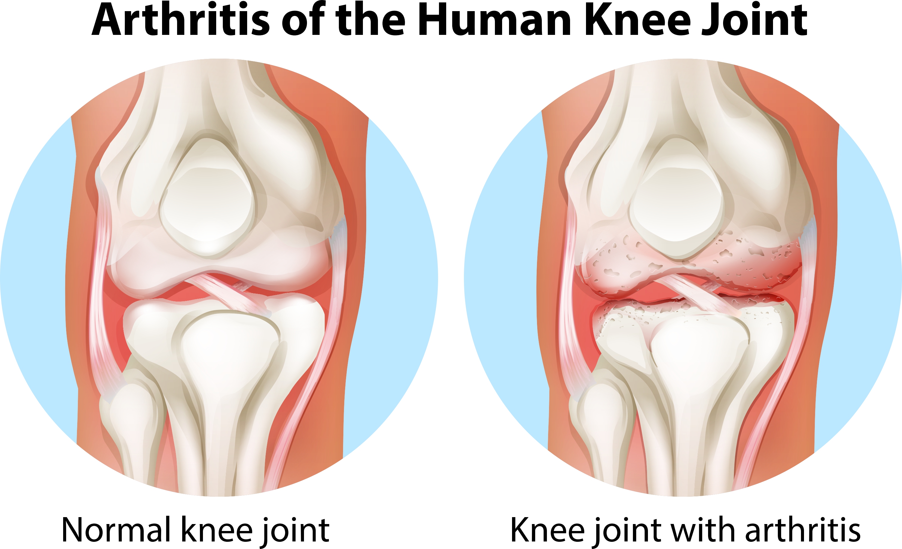 manual therapy for knee oa